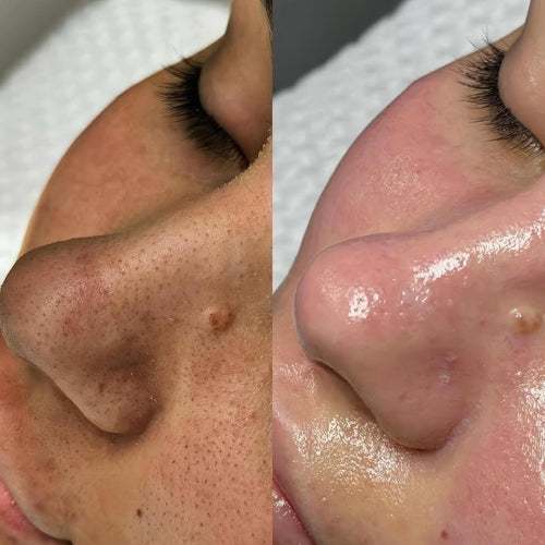 Lum K-Beauty Clarifying Serum — Pores, Blackheads & Sebum Control, 150ml