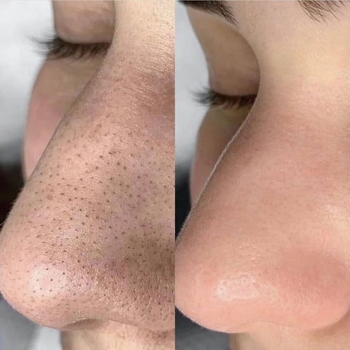 Lum K-Beauty Clarifying Serum — Pores, Blackheads & Sebum Control, 150ml